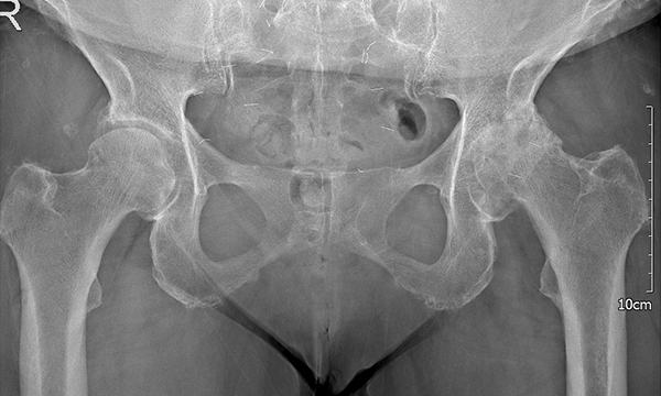 인공관절치환술